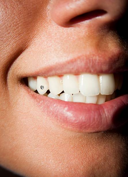 TOOTH GEM(S)